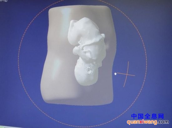 胎儿3D模型技术问世 或将取代传统超声照片
