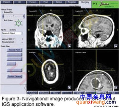 NDI Polaris计算机辅助治疗颅内手术应用