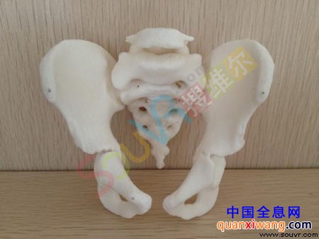 由3D打印机“打印”出来的患者盆骨关节